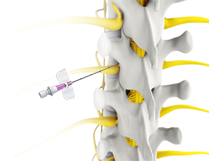 Spine Injection