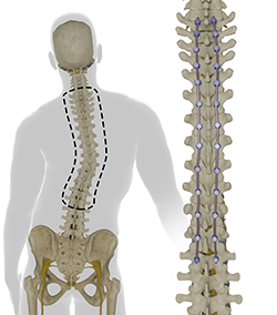 Adult Scoliosis Correction