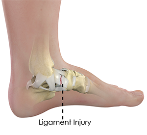 Ankle Ligament Injury