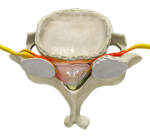 Cervical Stenosis