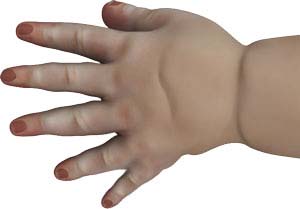 Congenital Defects of the Hand & Wrist