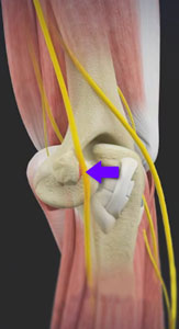 Cubital Tunnel Release (Medial Epicondylectomy)