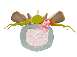 Cervical Disc Herniation