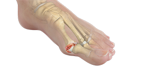 Stiff Big Toe (Hallux Rigidus)