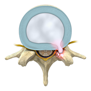 Lumbar Disc Herniation