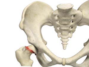 Slipped Capital Femoral Epiphysis (SCFE)