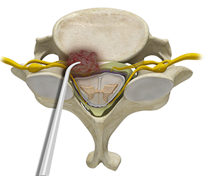 Spinal Tumor Surgery