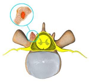 Spine Tumors