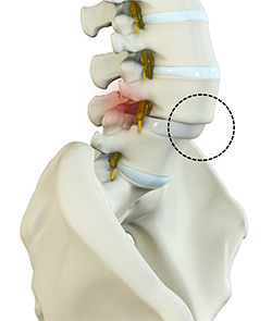 Spondylolisthesis