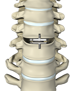 Total Disc Replacement