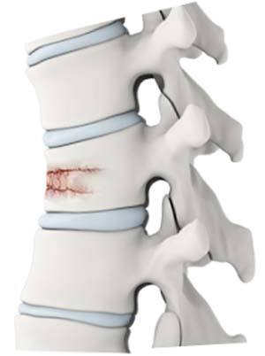 Vertebral Fractures